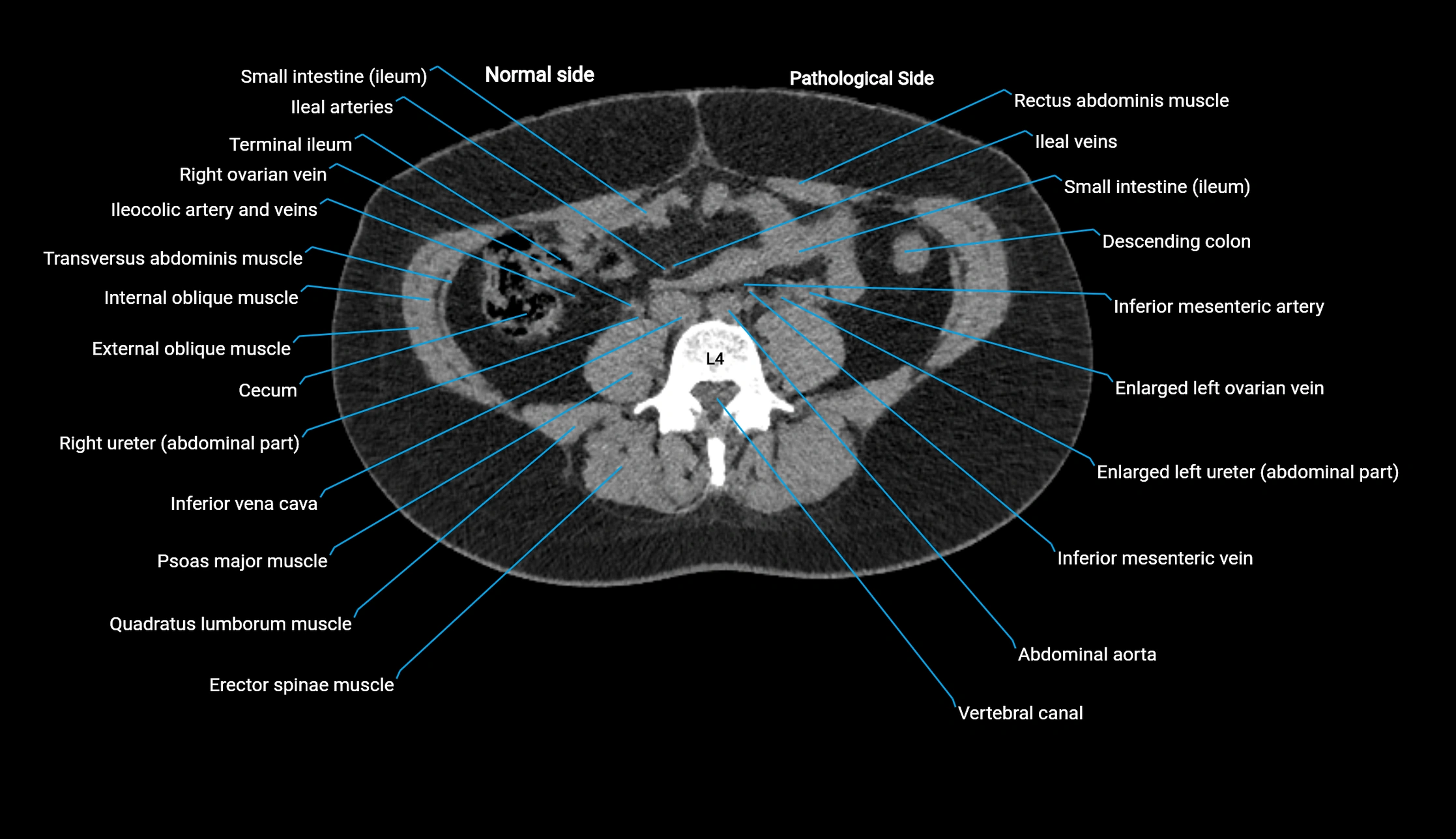 CT KUB axial cross sectional anatomy  radiology image -img-00201-00085.webp